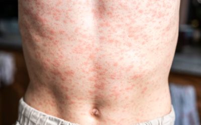 Salud pidió fortalecer la vigilancia por casos de sarampión